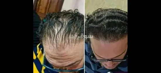 زيت تطويل الشعر وعلاج التقصف - 2