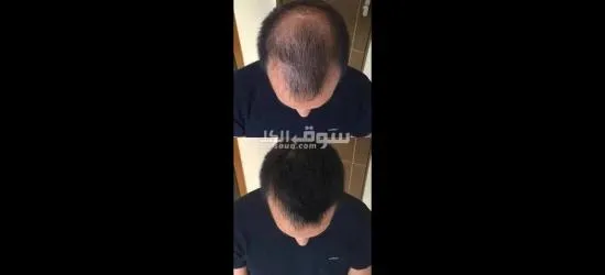زيت تطويل الشعر وعلاج التقصف - 4