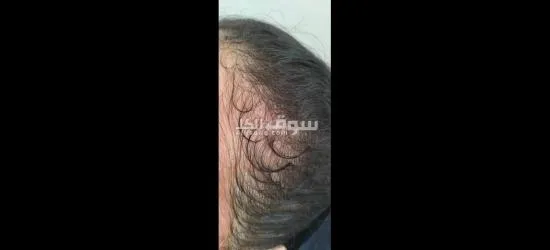 زيت تطويل الشعر وعلاج التقصف - 7